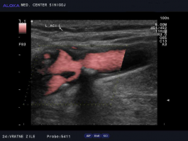 Ultrazvok vratnih žil - zožitev bulbusa in notranje karotidne arterije